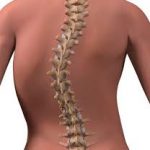 Deformaciones y terapias de la columna vertebral. Escoliosis.
